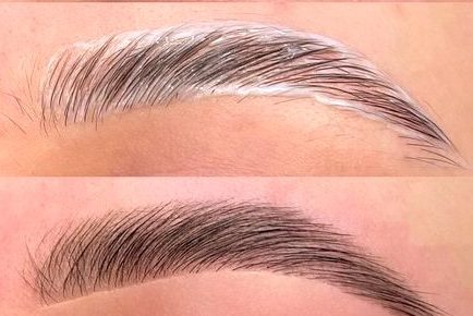 Brow lift